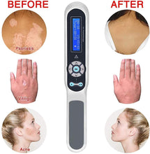 Load image into Gallery viewer, Kernel 311nm UVB Narrowband Phototherapy Lamp